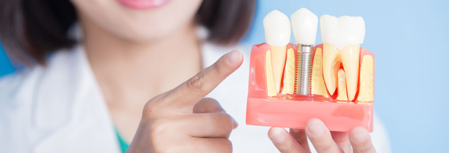 Avantages d’implant dentaire